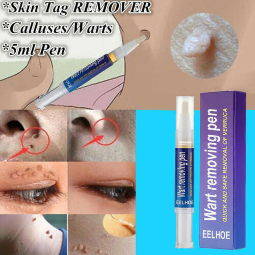 Warts & Moles Remover Pen (GUARNTEED RESULT)
