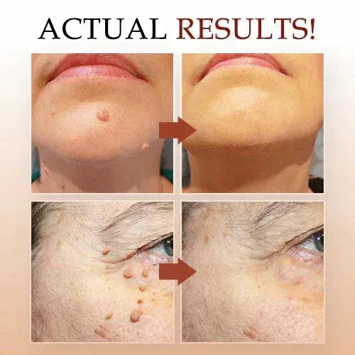 Warts & Moles Remover Pen (GUARNTEED RESULT)