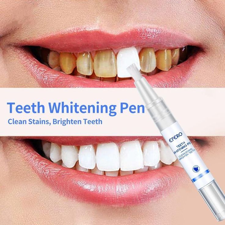 Dazzle Teeth Whitening Polish (Guaranteed Result)