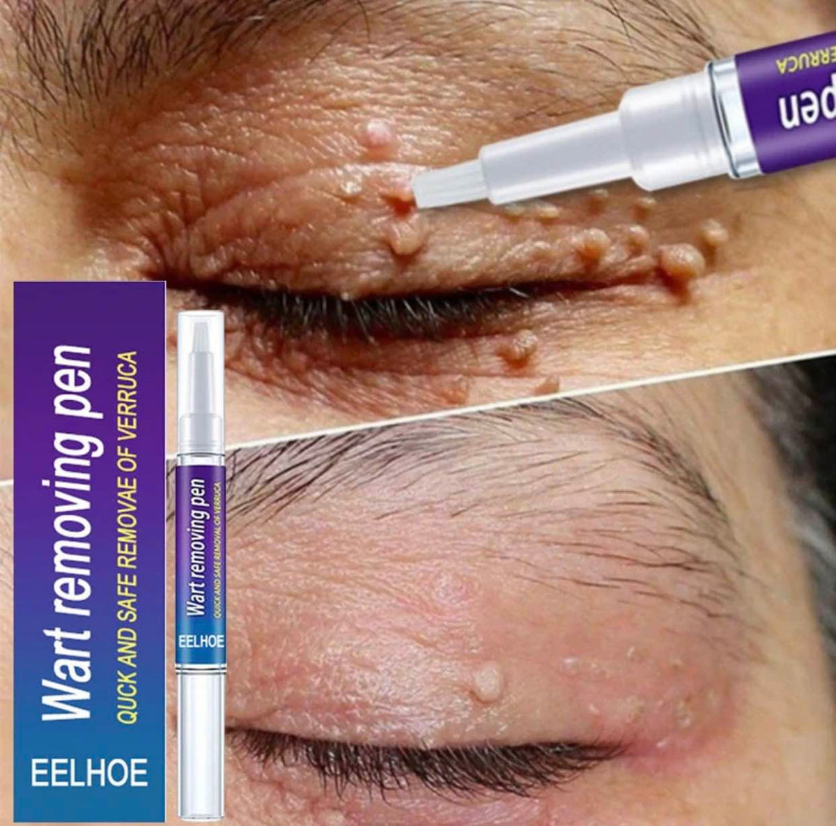 Warts & Moles Remover Pen (GUARNTEED RESULT)