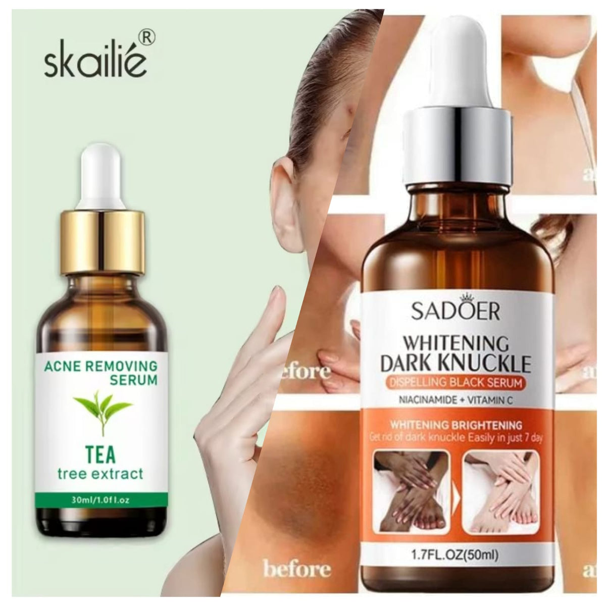 Acne Removing Face Serum 30ML & Whitening Body Serum For Dark Skin (Money Back Guarntee)
