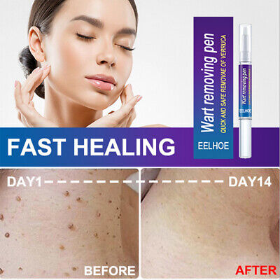 Warts & Moles Remover Pen (GUARNTEED RESULT)